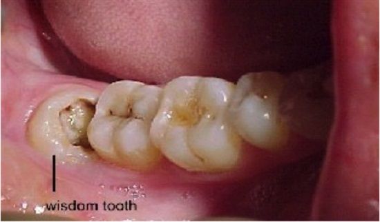 tooth disease