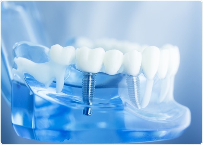 dental implants Sydney