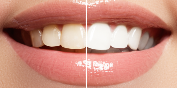 teeth whitening Essex