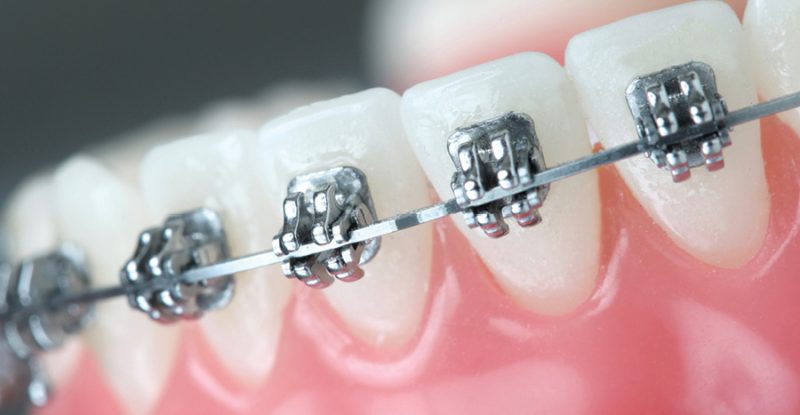 Orthodontic conditions