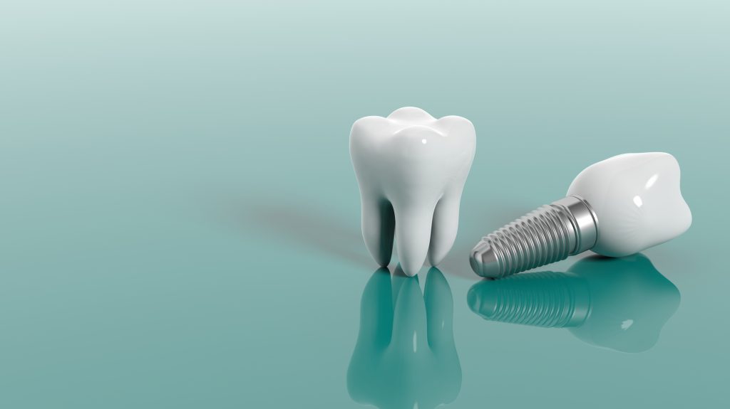 dental implant Melbourne