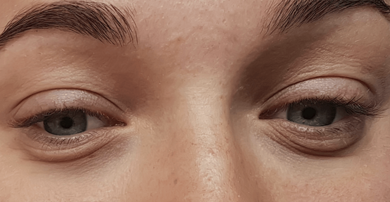 Learn about the eye bag removal treatments in Singapore