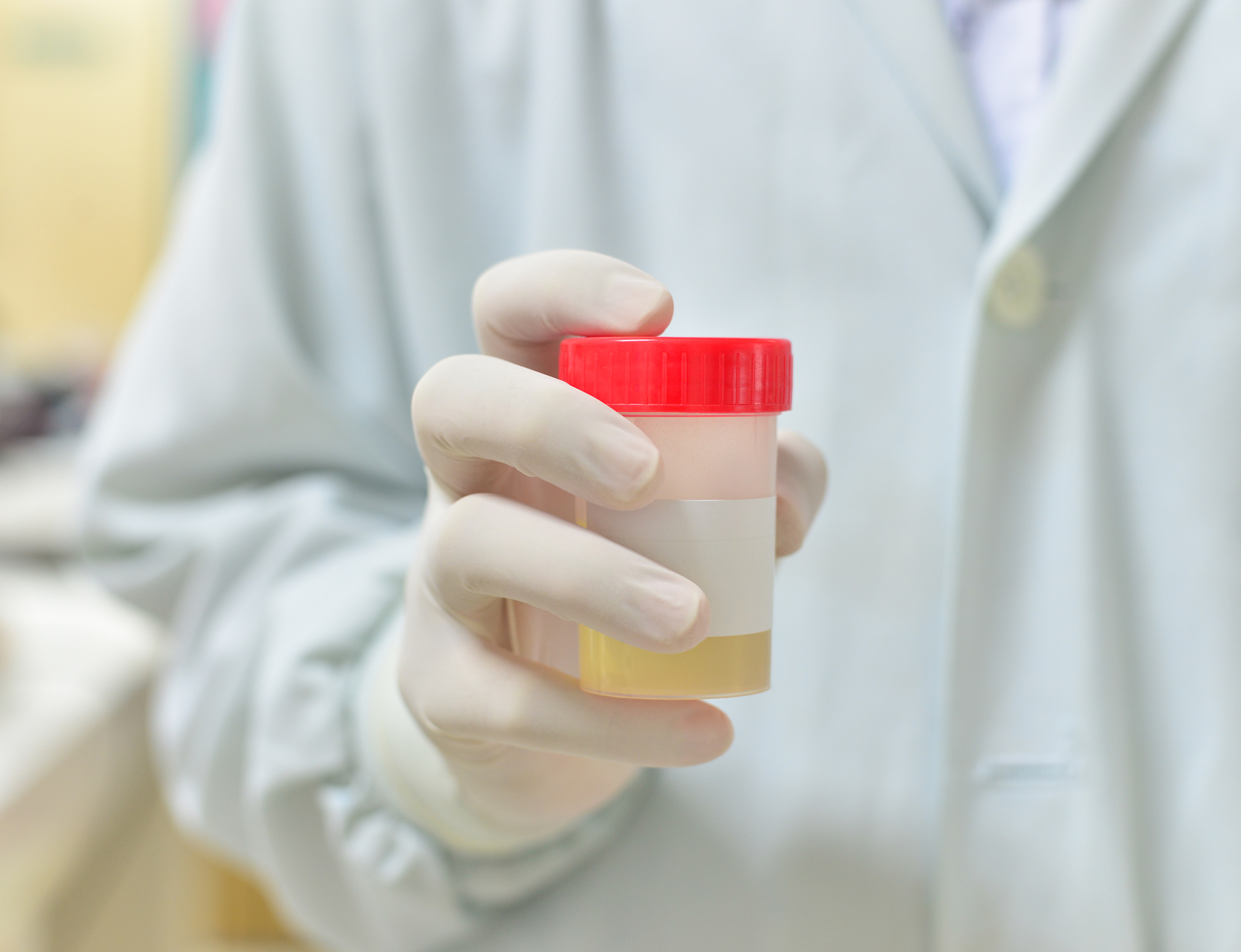 Urine sample bottle red urine in lab