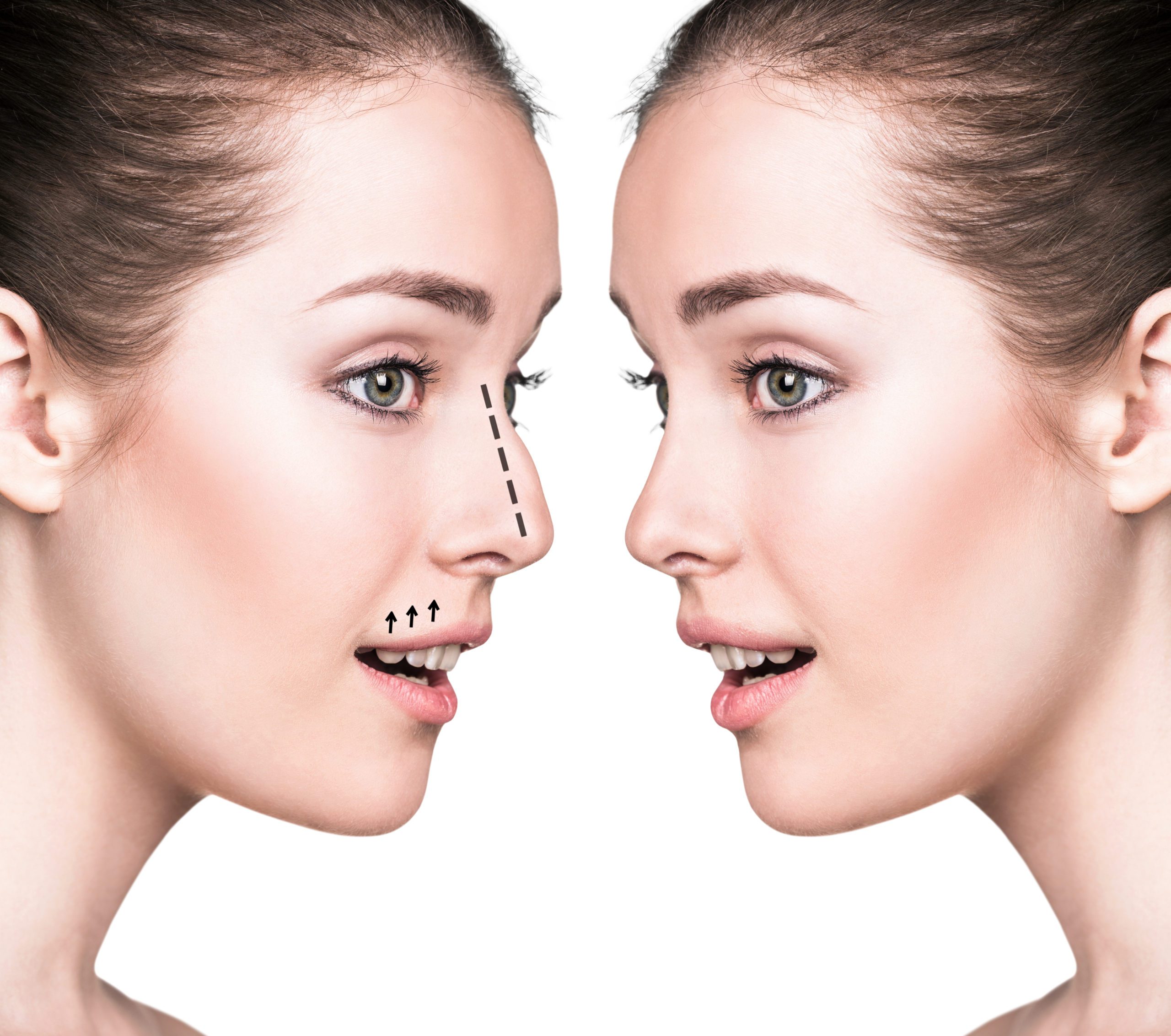 Different Types Of Rhinoplasty Procedures
